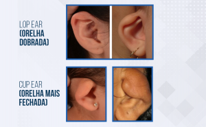 Tipos de orelha constricta
