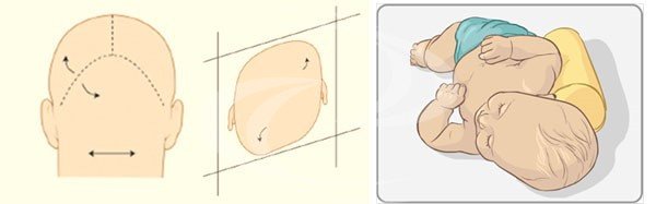 Plagiocefalia deformacional com seu aspecto em paralelogramo e o seu tratamento clínico com medidas posturais.