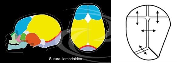 Suturas lambdóides assinaladas e esquema de uma plagiocefalia posterior mostrando o crescimento compensatório através das suturas não acometidas