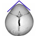 Esquema e aspecto tomográfico de uma trigonocefalia, com fechamento precoce da sutura metópica e aspecto triangular da fronte