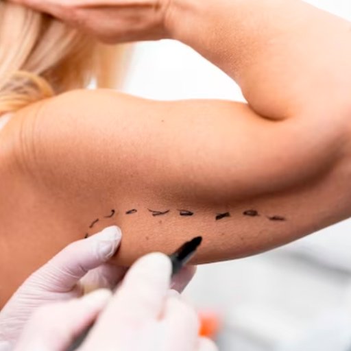 Braqueoplastia – Plástica de Braços