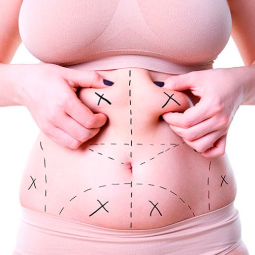 Lipoaspiração