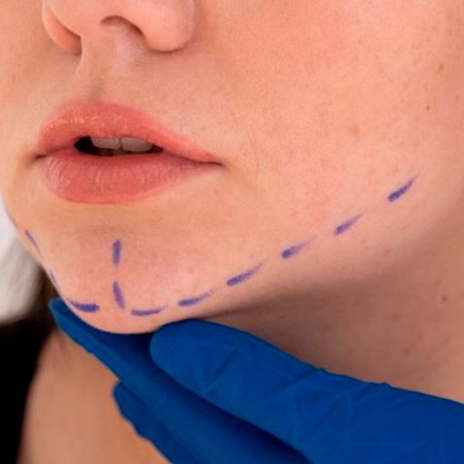 Mentoplastia – Plástica do Queixo