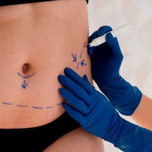Abdominoplastia – Plástica de Abdôme